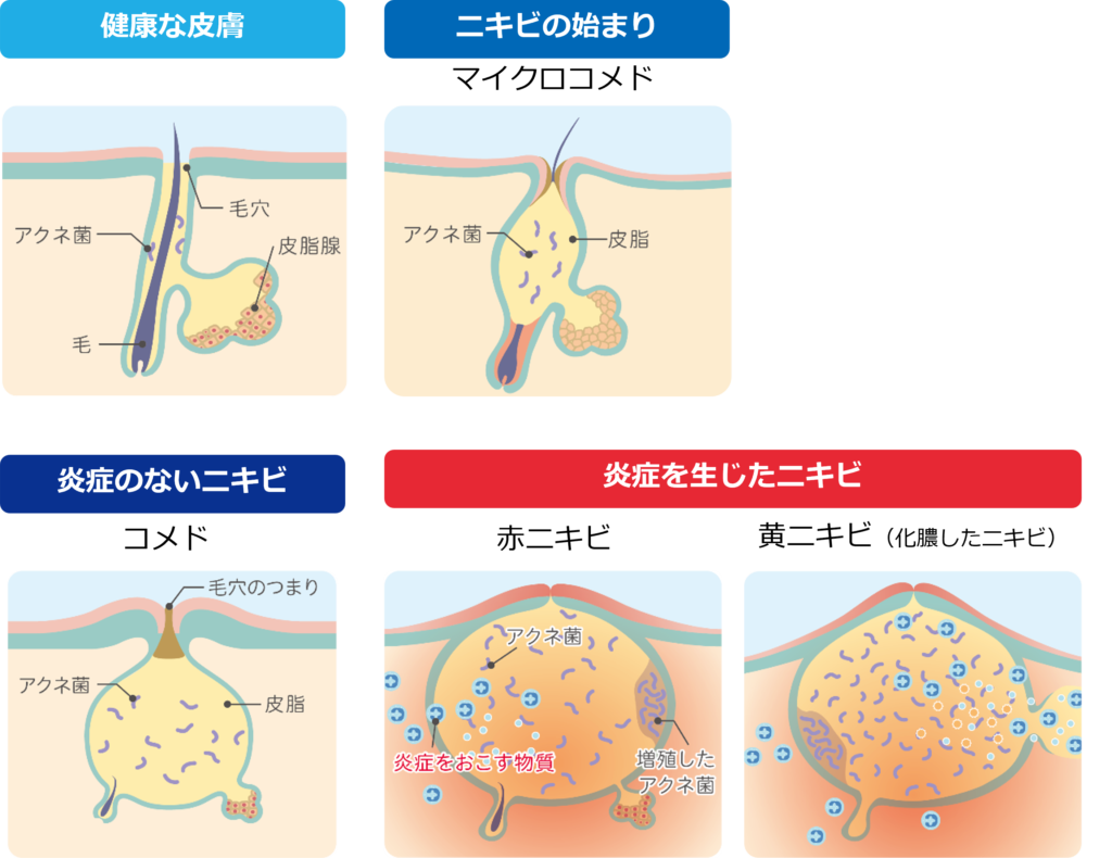 アクネ 菌 と は