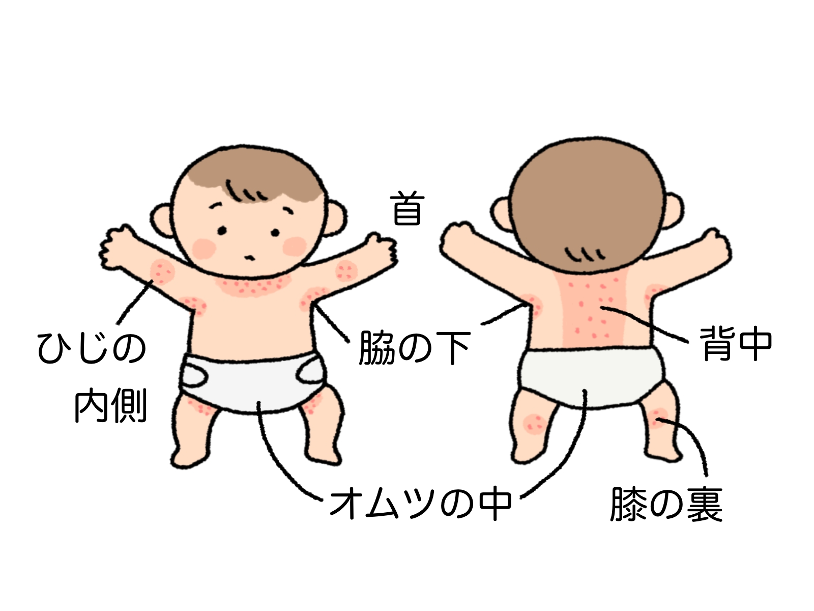 赤ちゃんのあせもができやすい場所