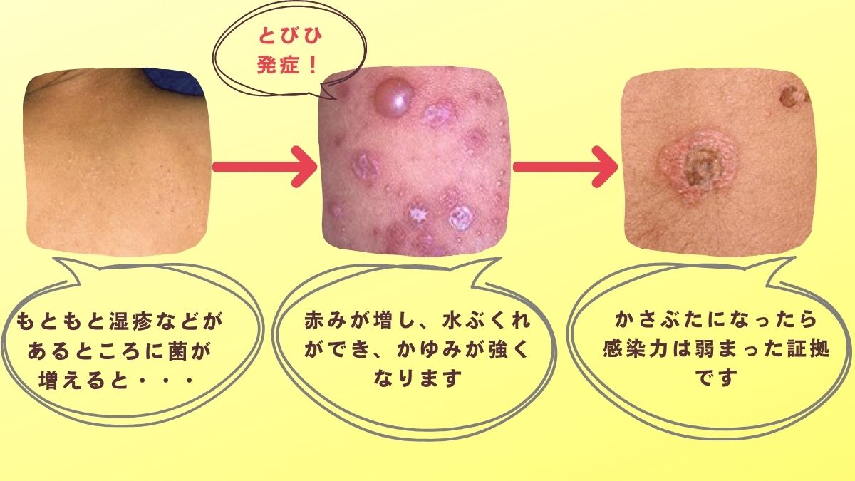 とびひの患部